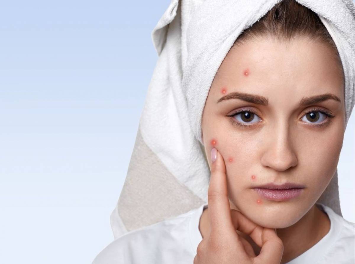 Sette regole d'oro per combattere l'acne nei cambi di stagione: soprattutto autunno e primavera