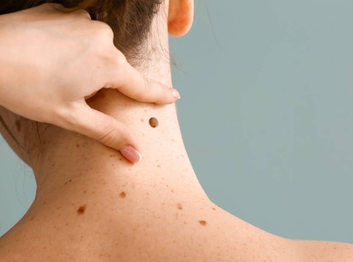 È possibile prevenire il Melanoma? Prima di tutto evitando le scottature fin dall'infanzia, causa dell'80% di questo tumore