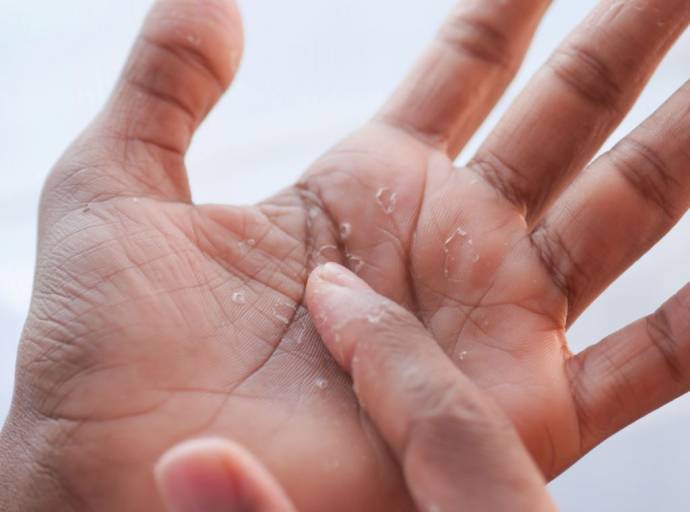 Disidrosi. Quando mani e piedi si riempiono di piccole vescicole pruriginose e fastidiose. Accade in primavera e estate