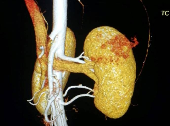 Dolore lombare, ematuria e varicocele: possibile sindrome dello Schiaccianoci da compressione della vena renale sinistra