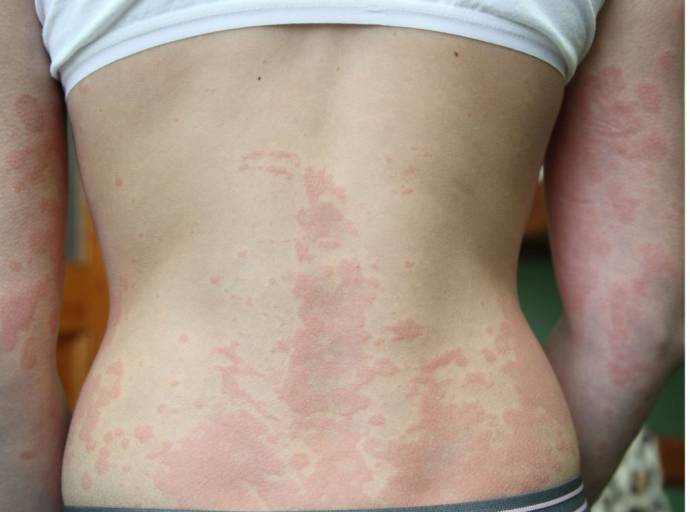 Orticaria colinergica, una cattiva compagnia. Quando il calore scatena prurito e ponfi sulla pelle: cause, sintomi e rimedi per riconoscerla e affrontarla con l’aiuto del medico