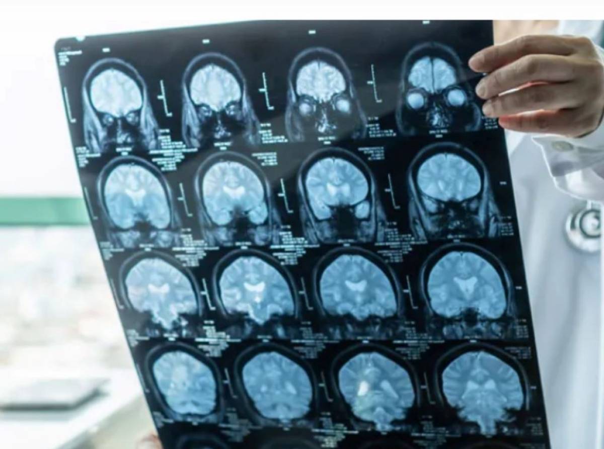 Alzheimer, quando una dimenticanza deve preoccupare? I 5 segnali da non sottovalutare