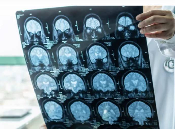 Alzheimer, quando una dimenticanza deve preoccupare? I 5 segnali da non sottovalutare