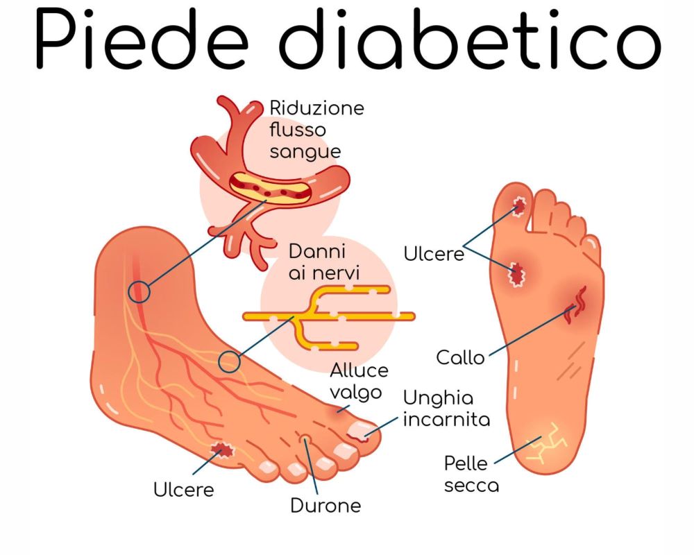 piede diabetico 1
